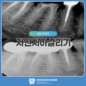 자연치아살리기