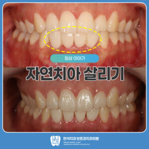 자연치아살리기