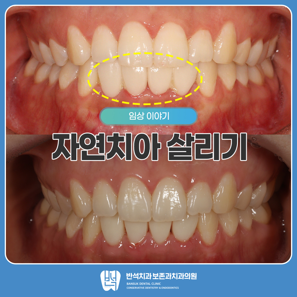 자연치아 살리기