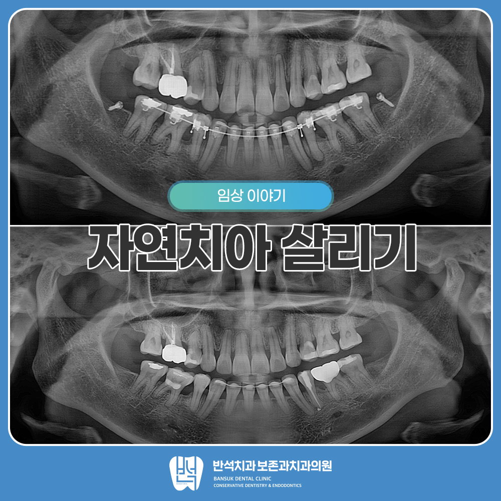 자연치아 살리기
