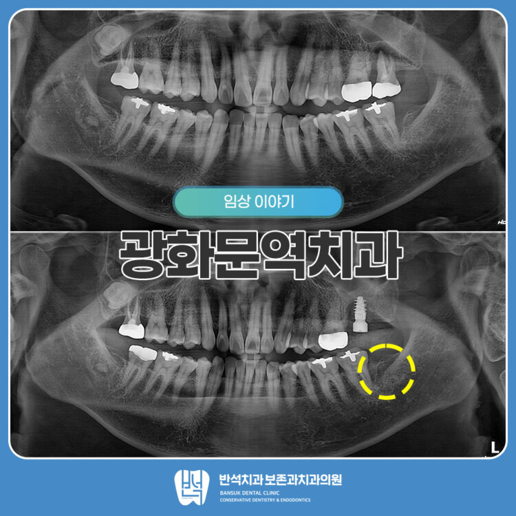 광화문역치과
