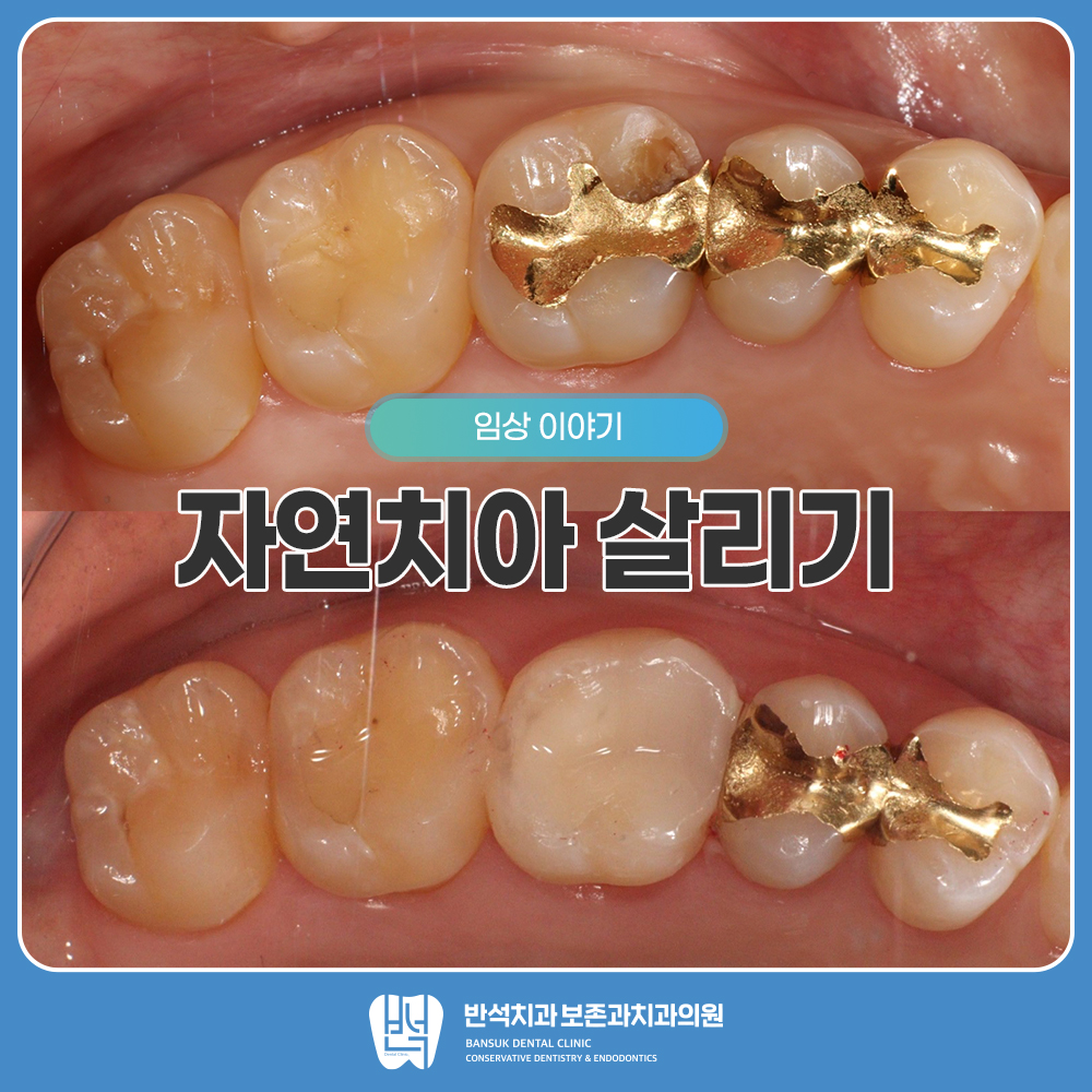 자연치아살리기