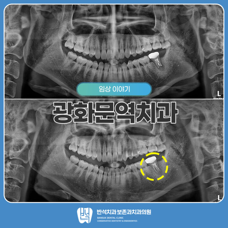 광화문역치과 